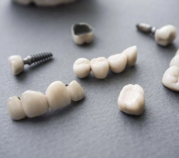 Dental implant posts, single crowns and a three-unit bridge laid out on a grey surface.