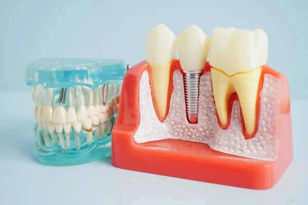 A cutaway model showing a dental implant post with a crown, set beside a model of a full set of teeth.