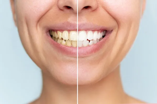 A close view of a smile, one half with yellowed teeth and the other half whiter.
