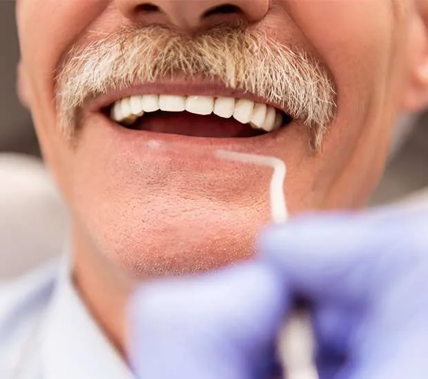 An older man with a moustache smiles while a gloved hand holds a dental tool near his lower lip.
