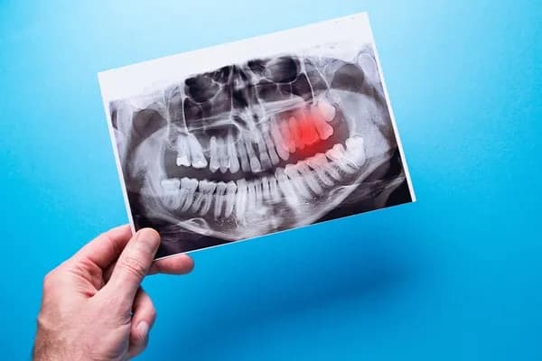 A hand holds up a panoramic dental x-ray with one back tooth highlighted in red.