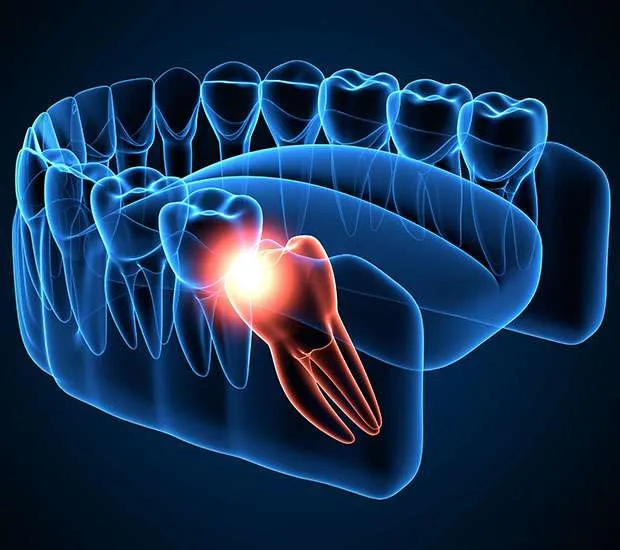 A 3D illustration of the lower jaw with a wisdom tooth highlighted.
