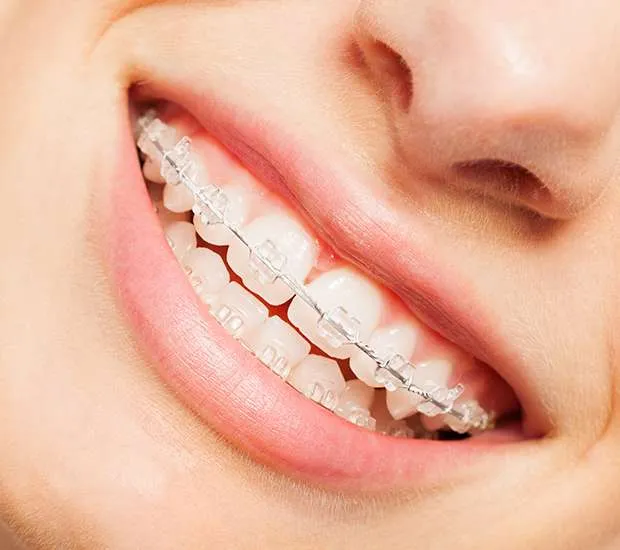 A close view of a smile with clear braces on the upper teeth.