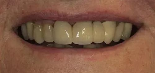After: an even row of front teeth.