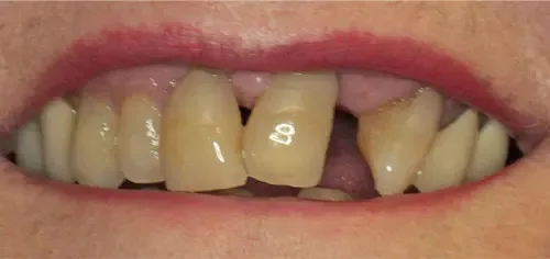Before: a crooked front tooth with a gap beside it.
