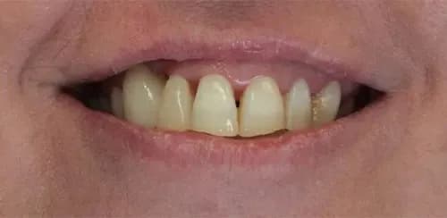 After: brighter, evenly shaped front teeth.