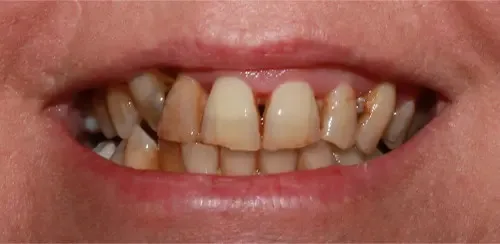 Before: stained, worn and uneven front teeth.