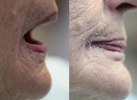 After: the same profile with the lips supported by new dentures.
