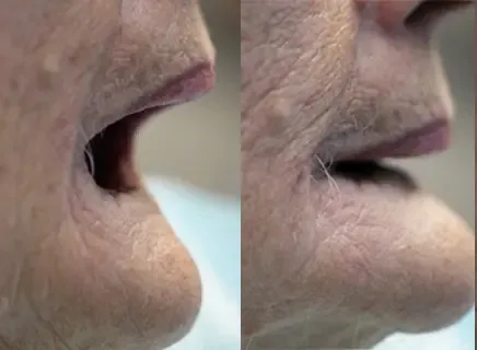 Before: a side profile with the lips sunken over loose dentures.