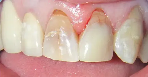 After: the same tooth rebuilt to its full shape.