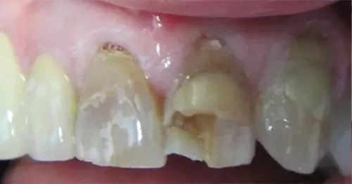 Before: a front tooth broken away at the edge.