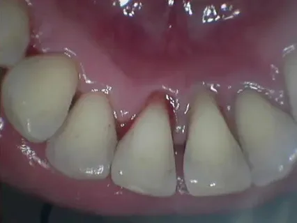 After: the same teeth cleaned, the gums clear.