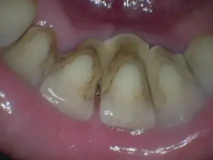 Before: lower front teeth with heavy tartar along the gums.