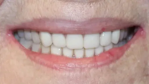 After: a full, even set of dentures.