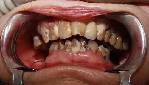 Before: heavily decayed and broken teeth throughout the mouth.