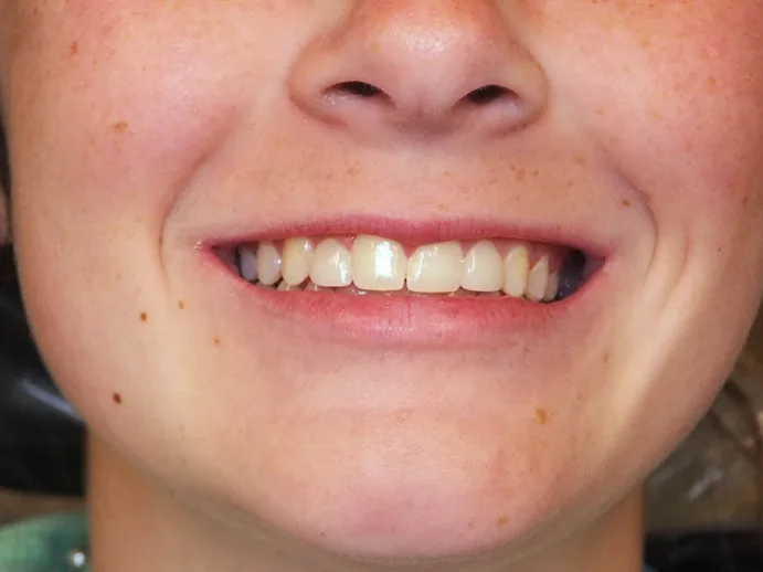 After: the same smile with the front teeth even and matched.
