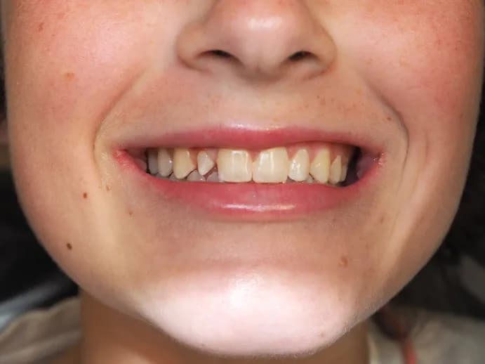 Before: a smile with one darker, uneven front tooth.