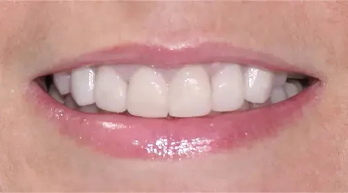After: a new set of veneers, even and bright.