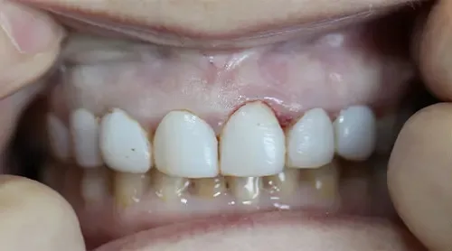 Before: front teeth with old veneers, stained and dark at the gumline.
