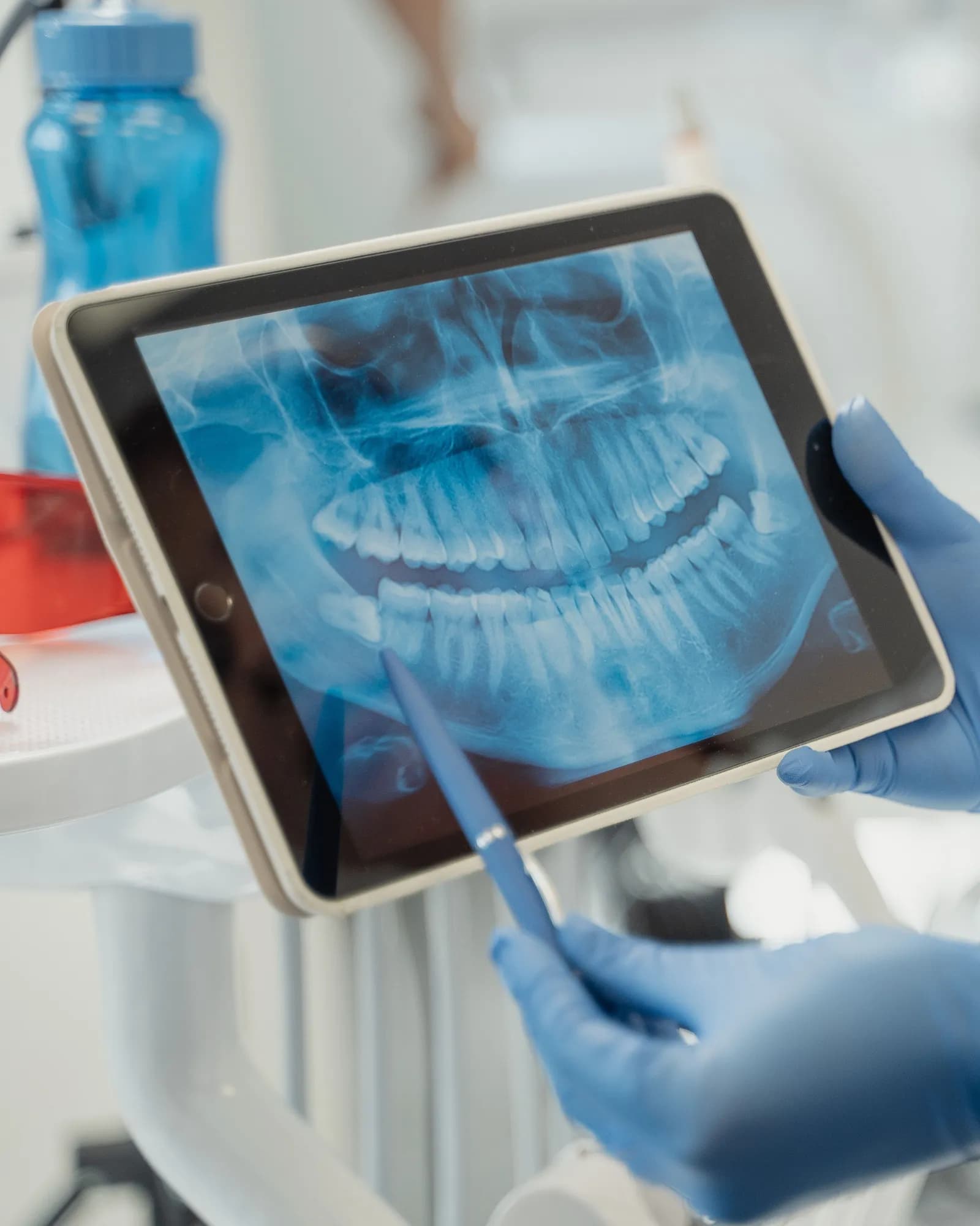 A panoramic dental x-ray on a tablet, with a gloved hand pointing at the lower jaw.