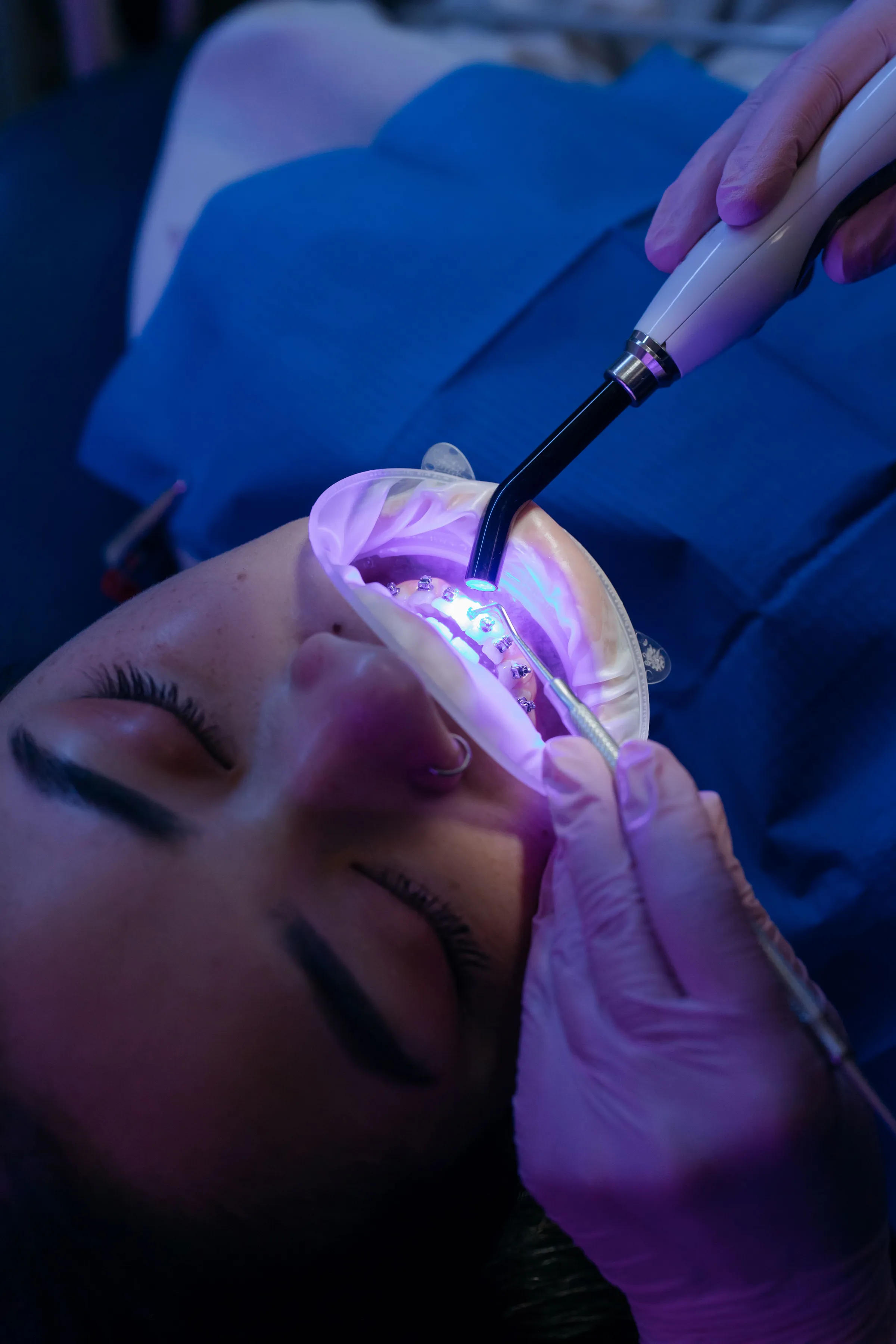 A patient reclined with a cheek retractor while a clinician works on her teeth under a blue light.