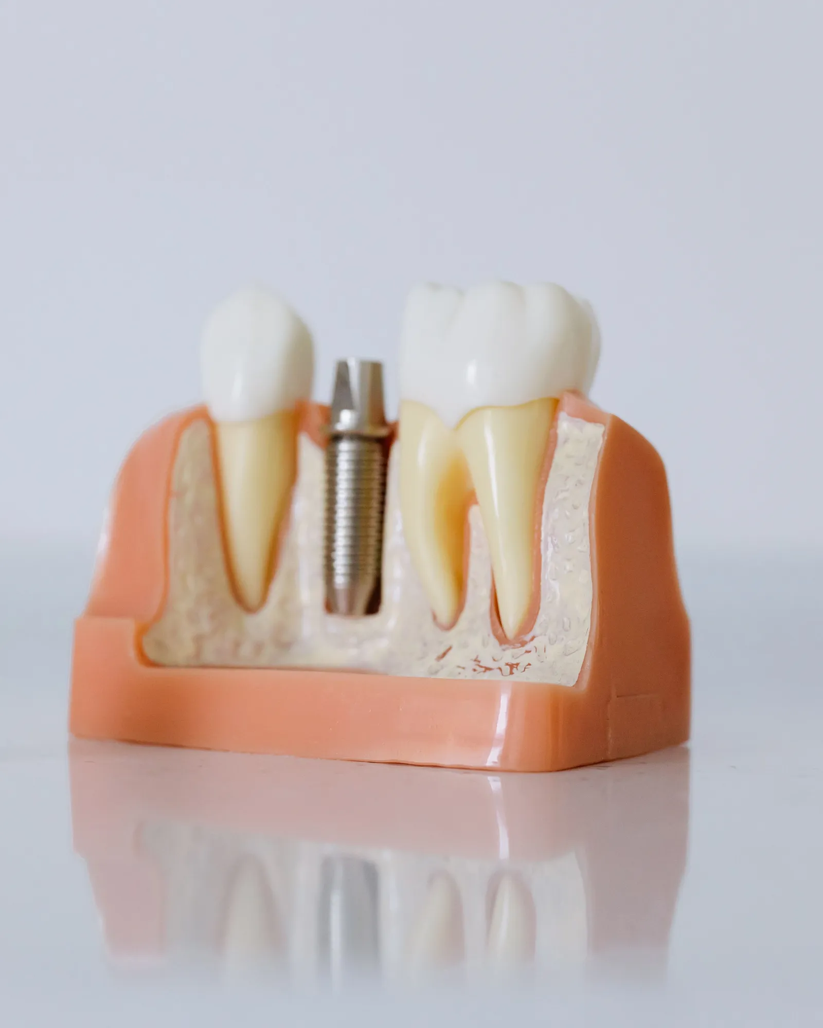 A dental model showing an implant set between two teeth.