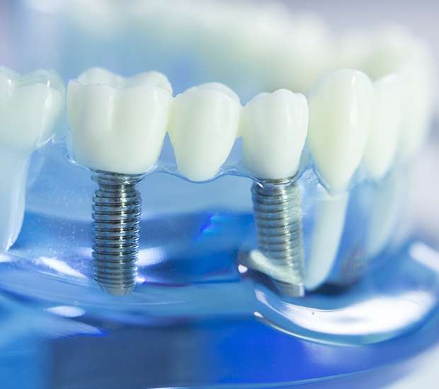 Winchester Dental Implants