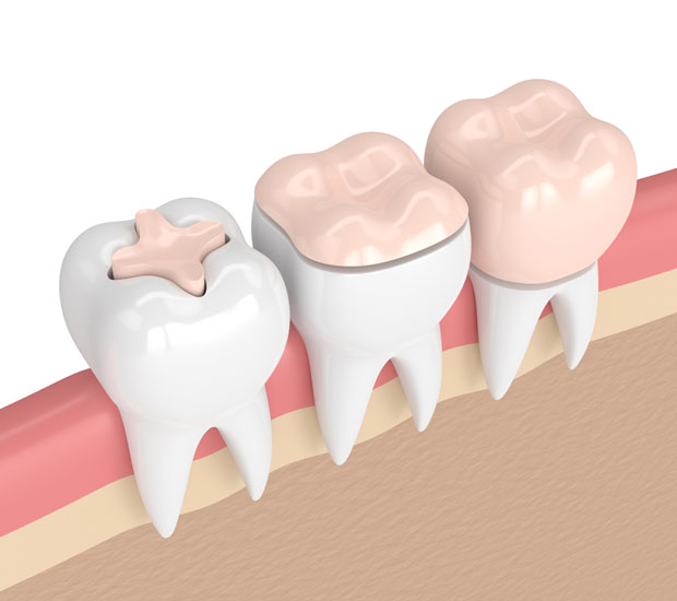 Winchester Dental Inlays and Onlays