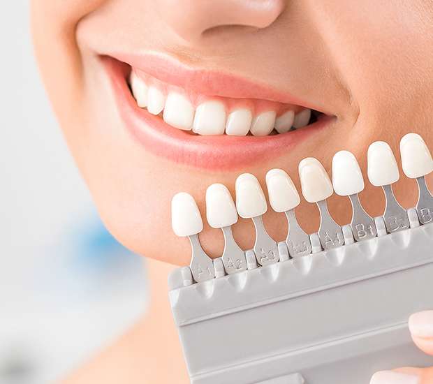 Winchester Dental Veneers and Dental Laminates